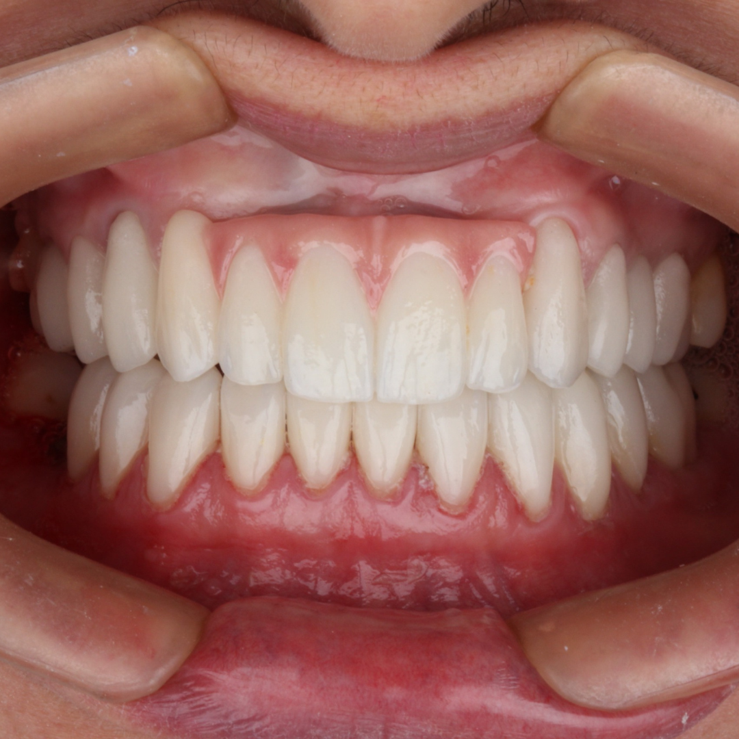 Reabilitação oral